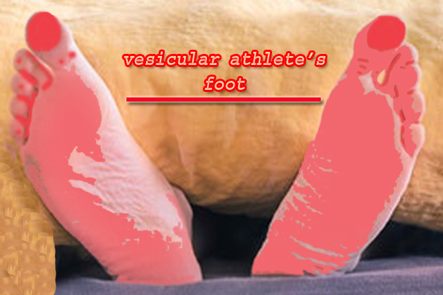Home Remedies for Vesicular Athlete's Foot