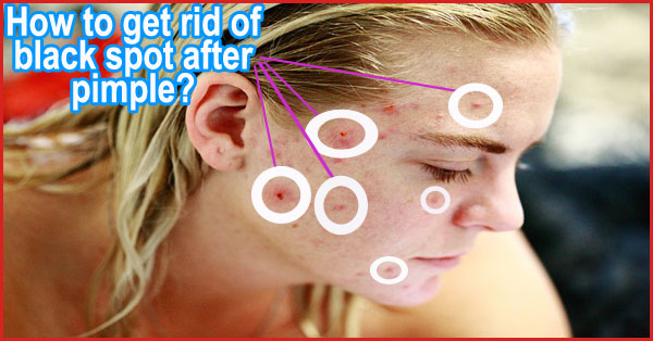 How to get rid of black spot after pimple